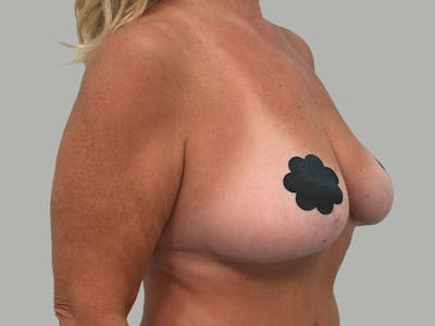Breast Augmentation-Mastopexy Before & After Gallery - Patient 424338 - Image 2