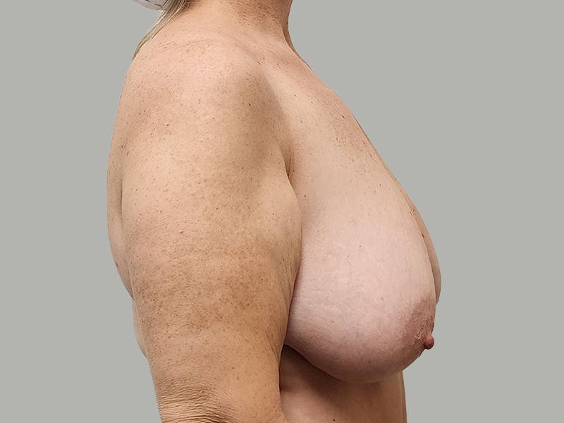 Breast Augmentation-Mastopexy Before & After Gallery - Patient 424338 - Image 3