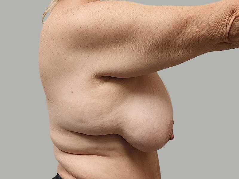 Breast Augmentation-Mastopexy Before & After Gallery - Patient 424338 - Image 5