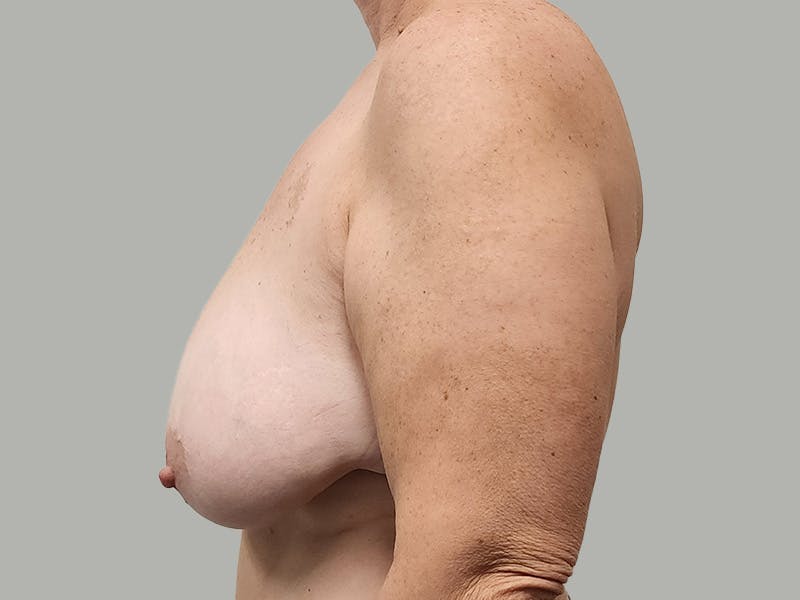 Breast Augmentation-Mastopexy Before & After Gallery - Patient 424338 - Image 7