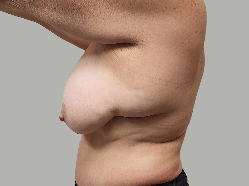 Breast Augmentation-Mastopexy Before & After Gallery - Patient 424338 - Image 9