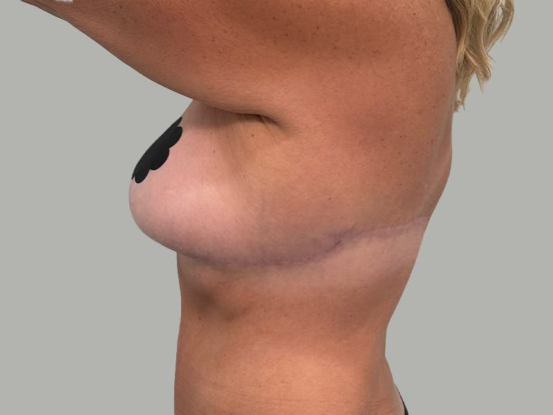Breast Augmentation-Mastopexy Before & After Gallery - Patient 424338 - Image 10