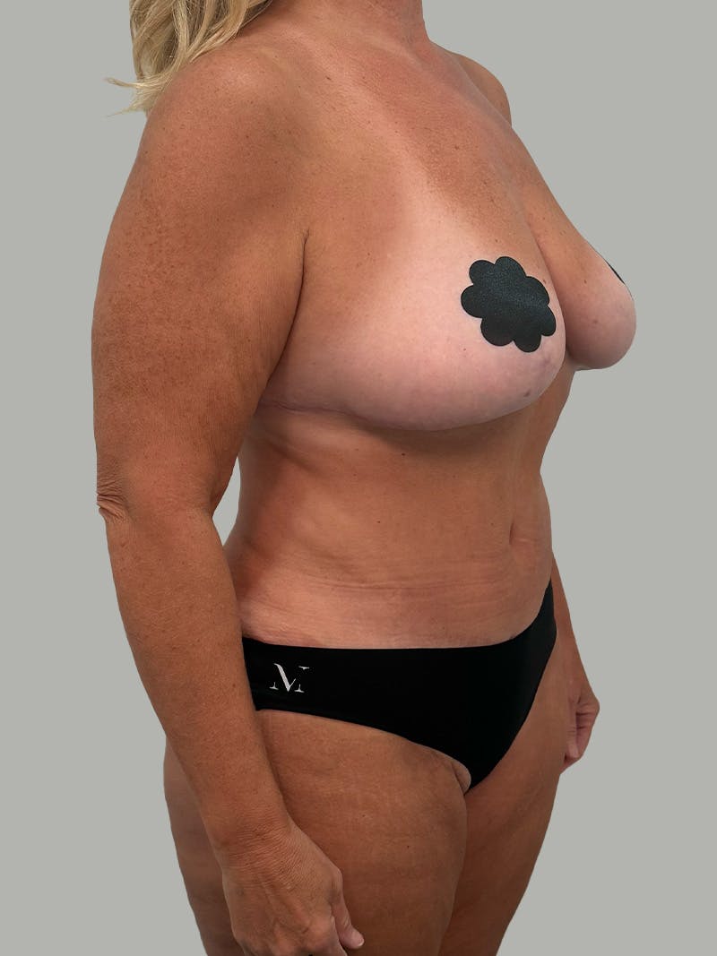 Upper Back Lift Before & After Gallery - Patient 134215 - Image 4
