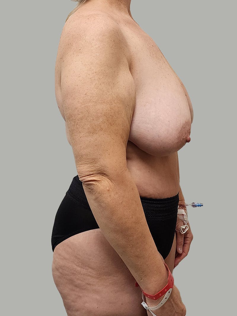 Upper Back Lift Before & After Gallery - Patient 134215 - Image 5