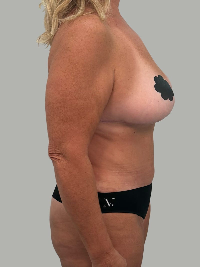 Upper Back Lift Before & After Gallery - Patient 134215 - Image 6