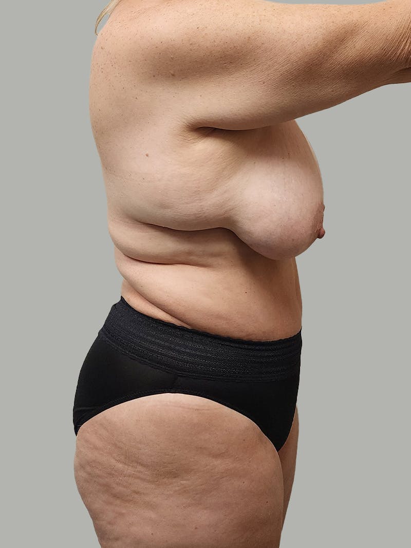 Upper Back Lift Before & After Gallery - Patient 134215 - Image 7