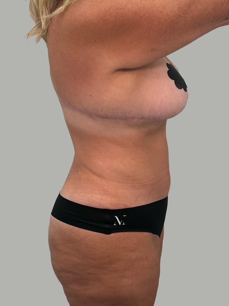 Upper Back Lift Before & After Gallery - Patient 134215 - Image 8