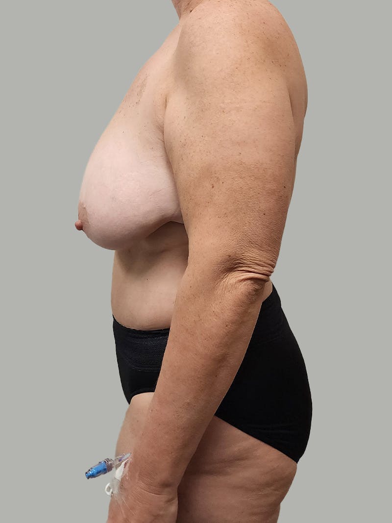 Upper Back Lift Before & After Gallery - Patient 134215 - Image 9