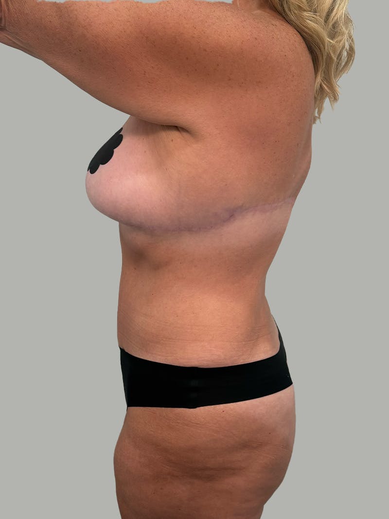 Upper Back Lift Before & After Gallery - Patient 134215 - Image 12