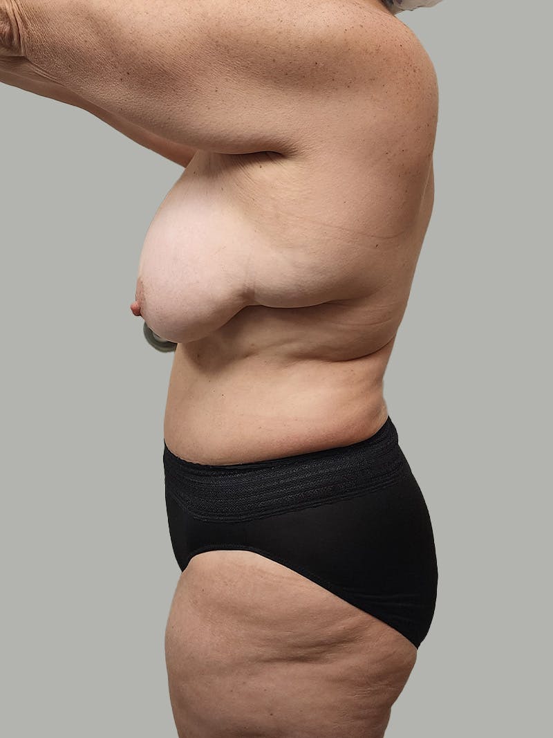 Upper Back Lift Before & After Gallery - Patient 134215 - Image 11