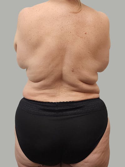 Upper Back Lift Before & After Gallery - Patient 134215 - Image 1