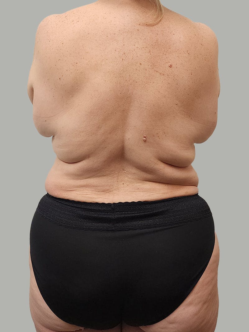 Upper Back Lift Before & After Gallery - Patient 134215 - Image 1