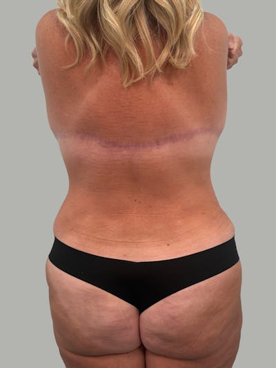Upper Back Lift Before & After Gallery - Patient 134215 - Image 2