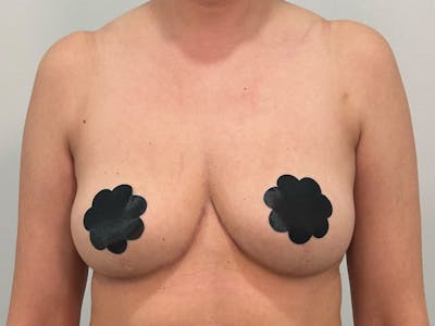 Breast Augmentation-Mastopexy Before & After Gallery - Patient 379956 - Image 2