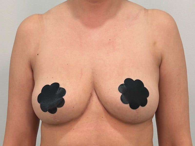 Breast Augmentation-Mastopexy Before & After Gallery - Patient 379956 - Image 2