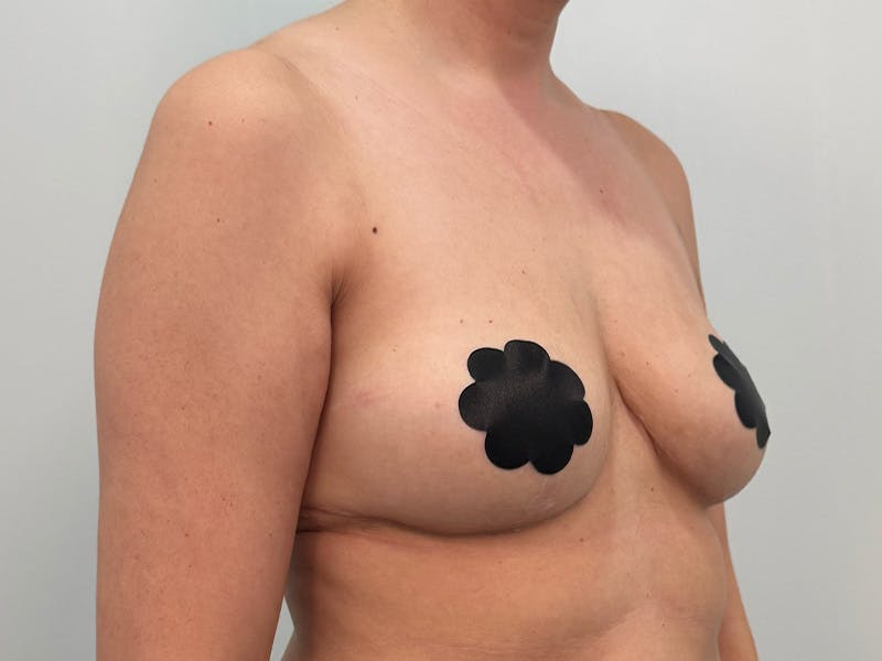 Breast Augmentation-Mastopexy Before & After Gallery - Patient 379956 - Image 4