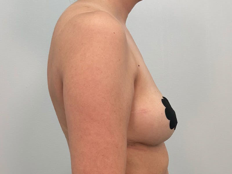 Breast Augmentation-Mastopexy Before & After Gallery - Patient 379956 - Image 6