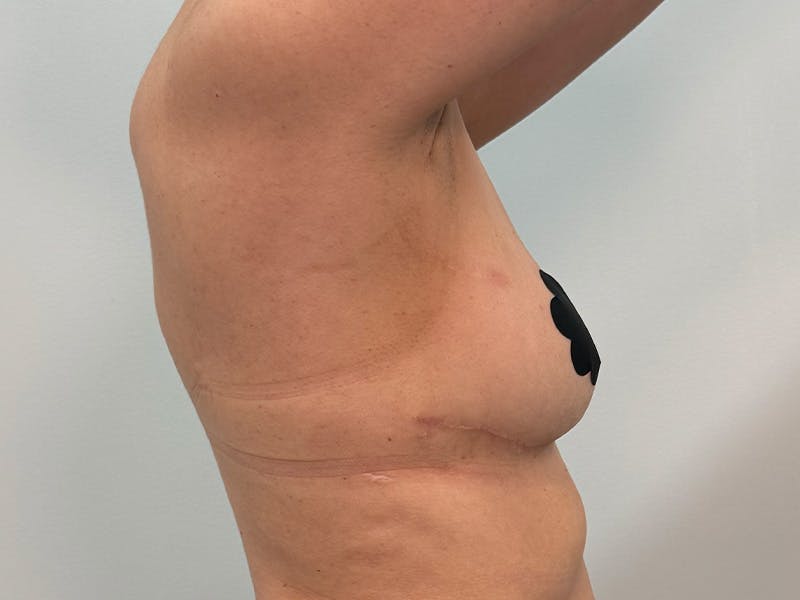 Breast Augmentation-Mastopexy Before & After Gallery - Patient 379956 - Image 9
