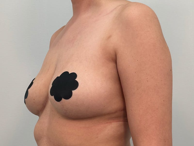 Breast Augmentation-Mastopexy Before & After Gallery - Patient 379956 - Image 8
