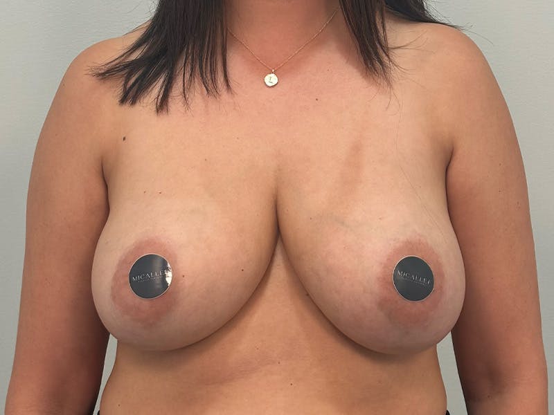 Breast Augmentation-Mastopexy Before & After Gallery - Patient 379956 - Image 1