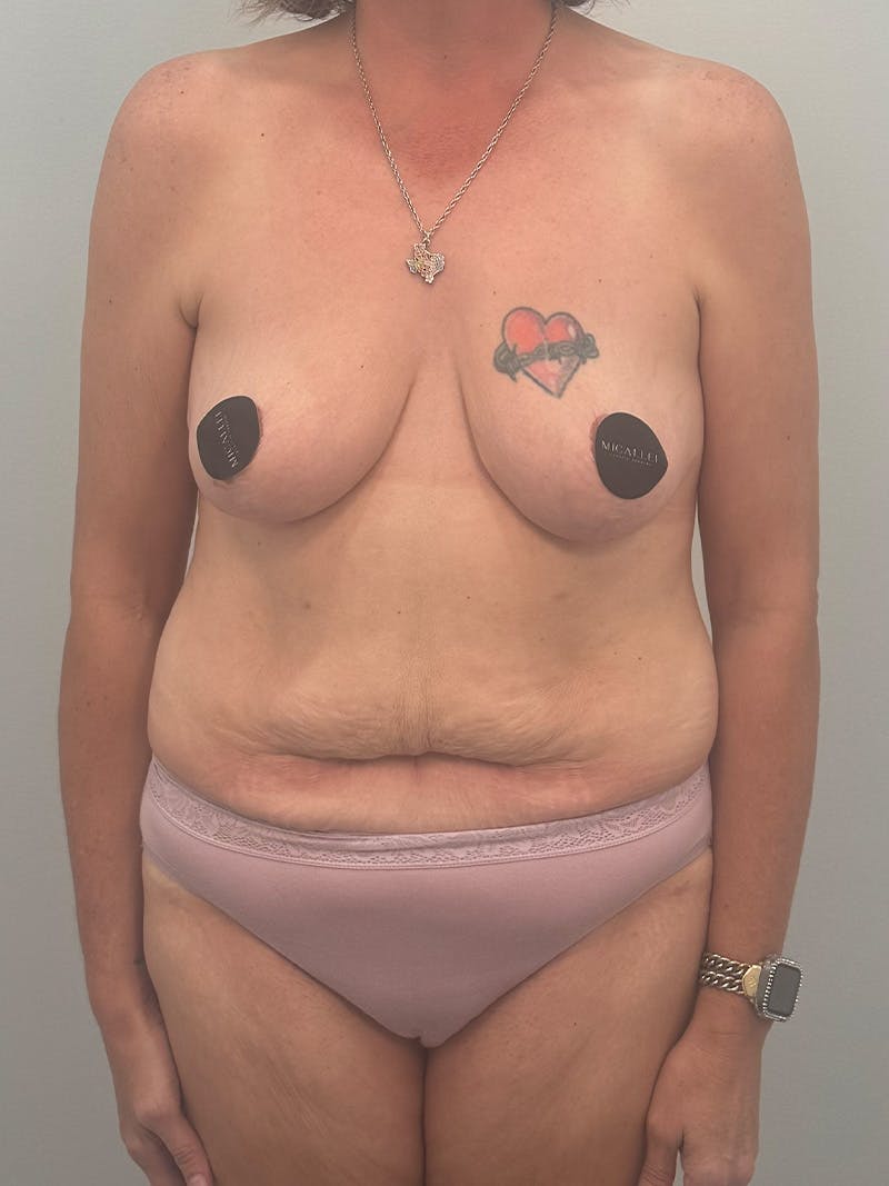 Mommy Makeover Before & After Gallery - Patient 293327 - Image 1