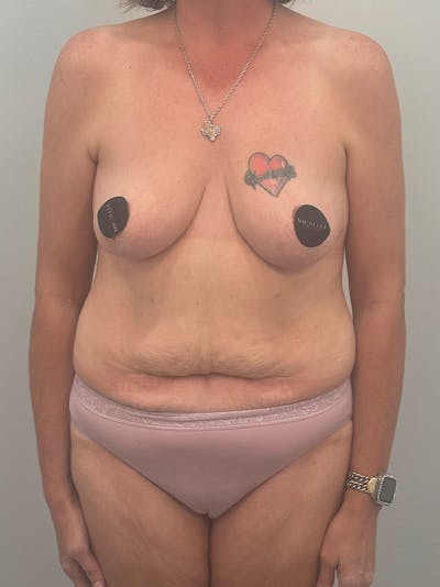 Mommy Makeover Before & After Gallery - Patient 293327 - Image 1