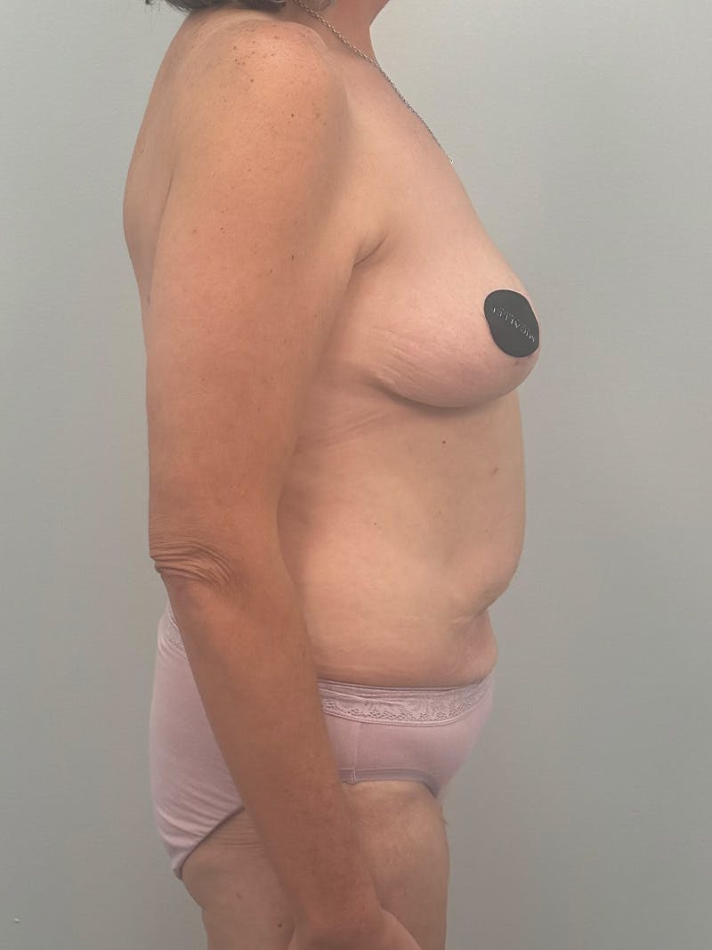 Mommy Makeover Before & After Gallery - Patient 293327 - Image 5
