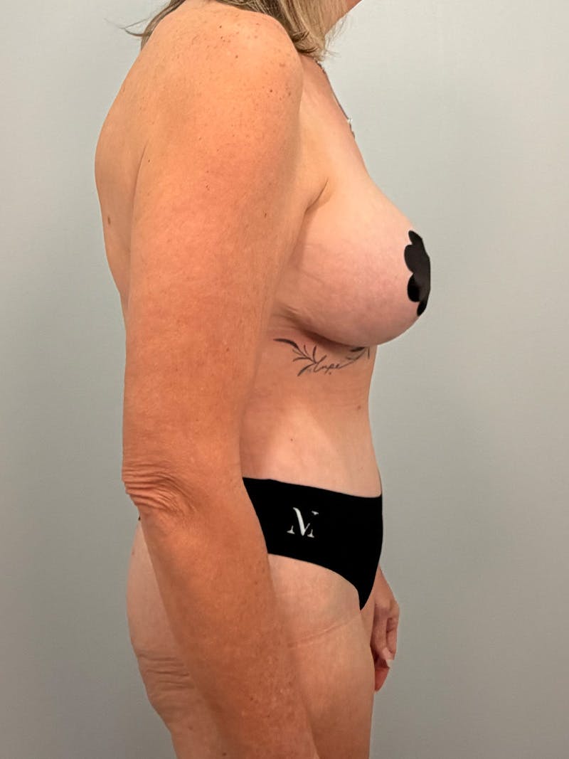 Mommy Makeover Before & After Gallery - Patient 293327 - Image 6