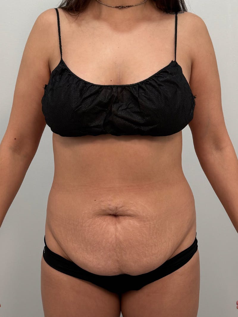 Brazilian Butt Lift Before & After Gallery - Patient 823915 - Image 3