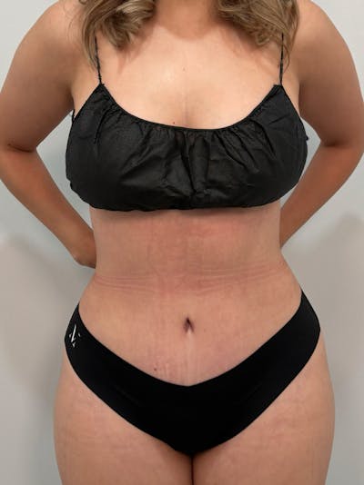 Tummy Tuck Before & After Gallery - Patient 400144 - Image 2