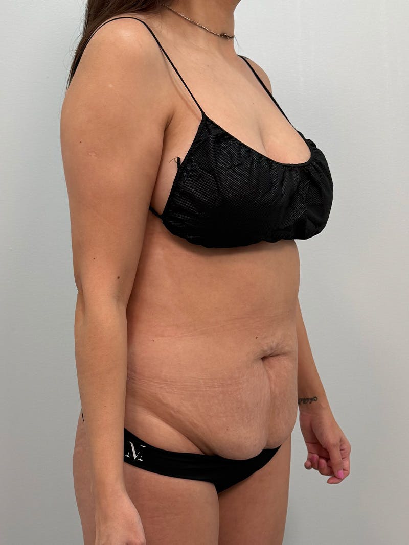Brazilian Butt Lift Before & After Gallery - Patient 823915 - Image 5
