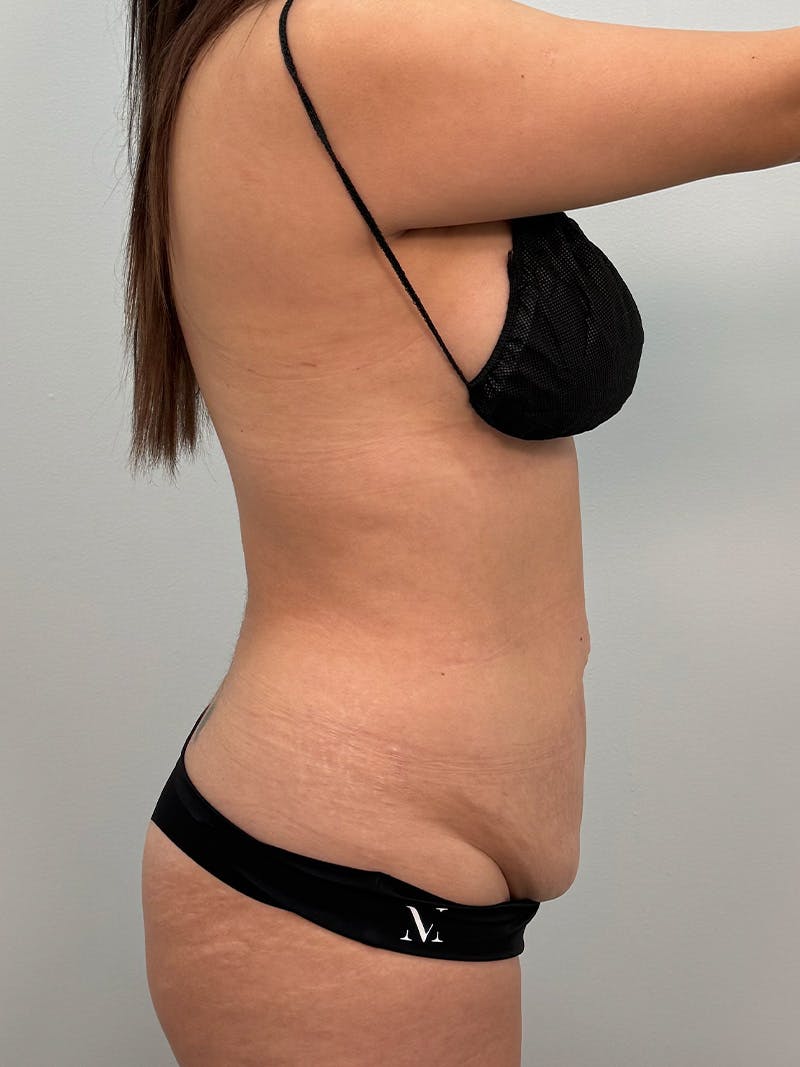 Brazilian Butt Lift Before & After Gallery - Patient 823915 - Image 7