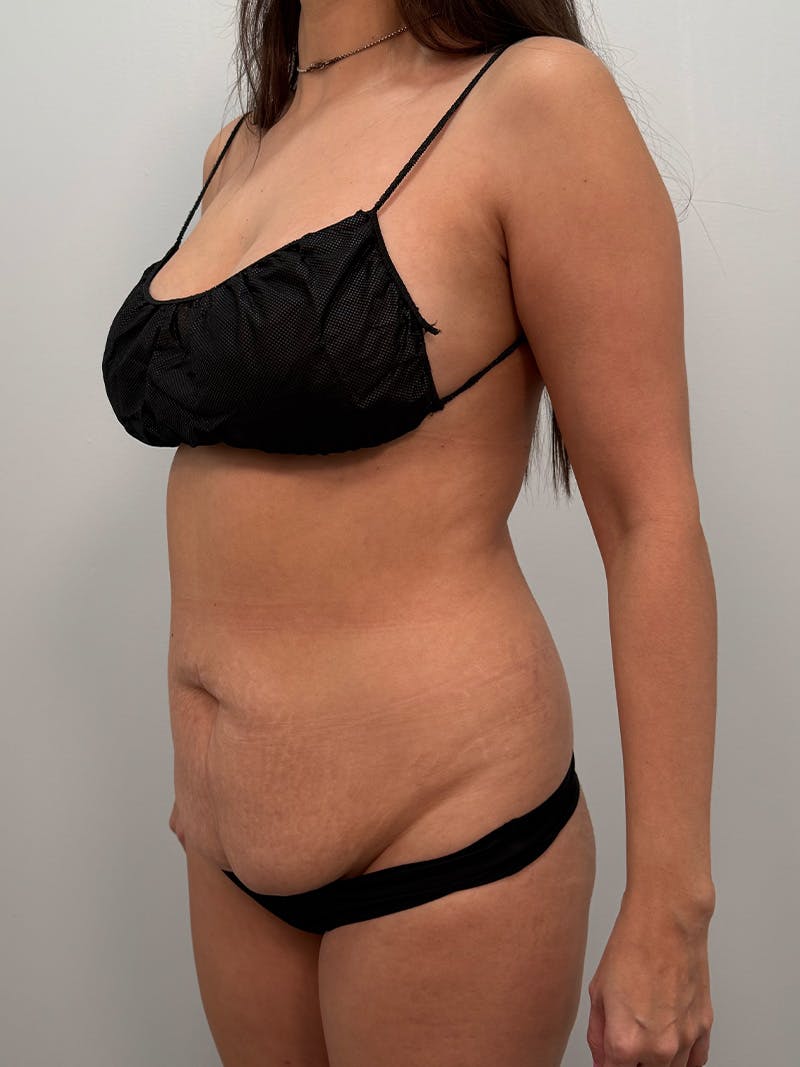 Brazilian Butt Lift Before & After Gallery - Patient 823915 - Image 9