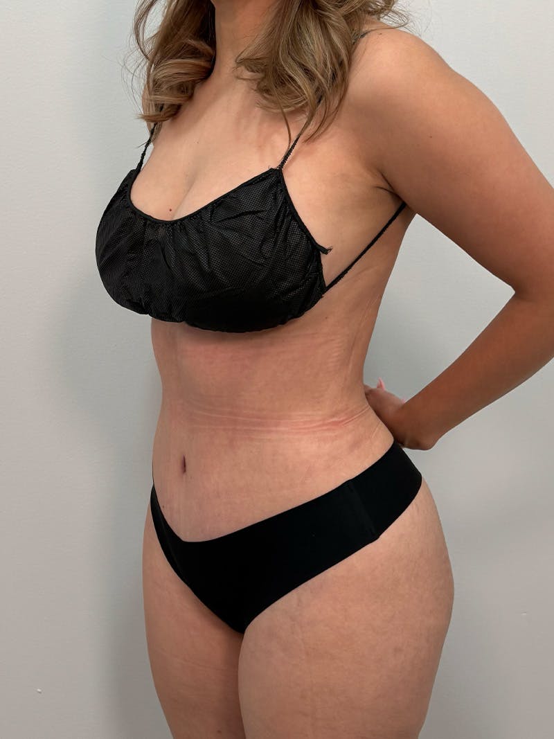 Brazilian Butt Lift Before & After Gallery - Patient 823915 - Image 10