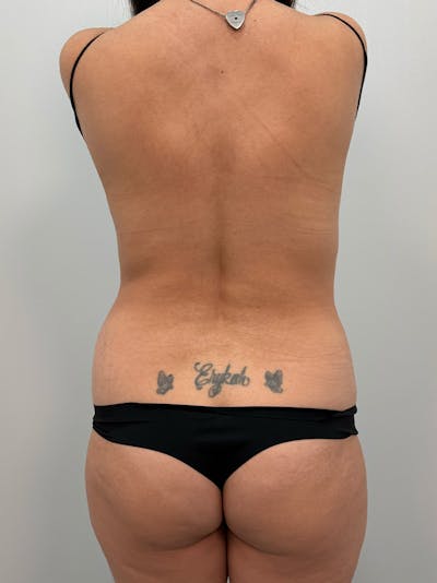 Brazilian Butt Lift Before & After Gallery - Patient 823915 - Image 1
