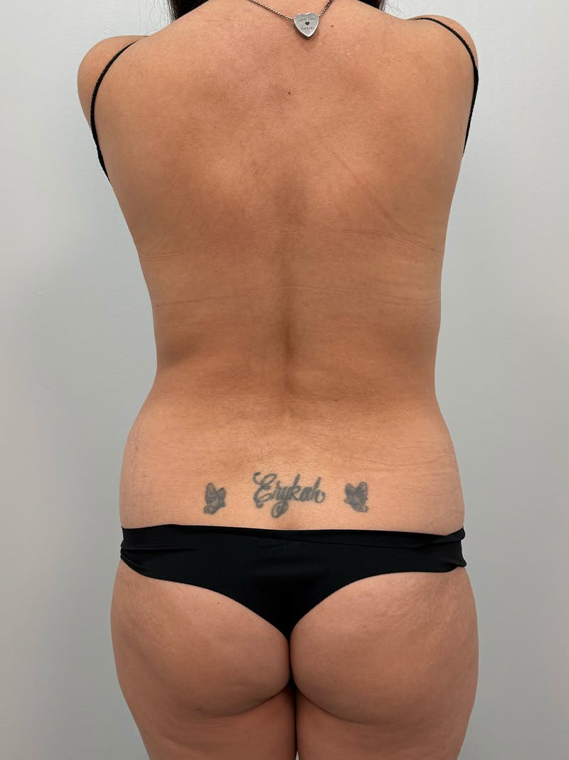 Brazilian Butt Lift Before & After Gallery - Patient 823915 - Image 1
