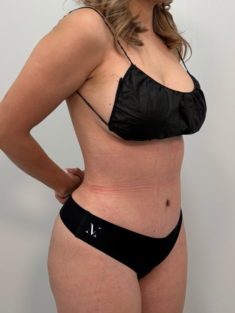 Brazilian Butt Lift Before & After Gallery - Patient 823915 - Image 6