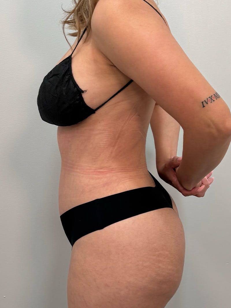 Brazilian Butt Lift Before & After Gallery - Patient 823915 - Image 12