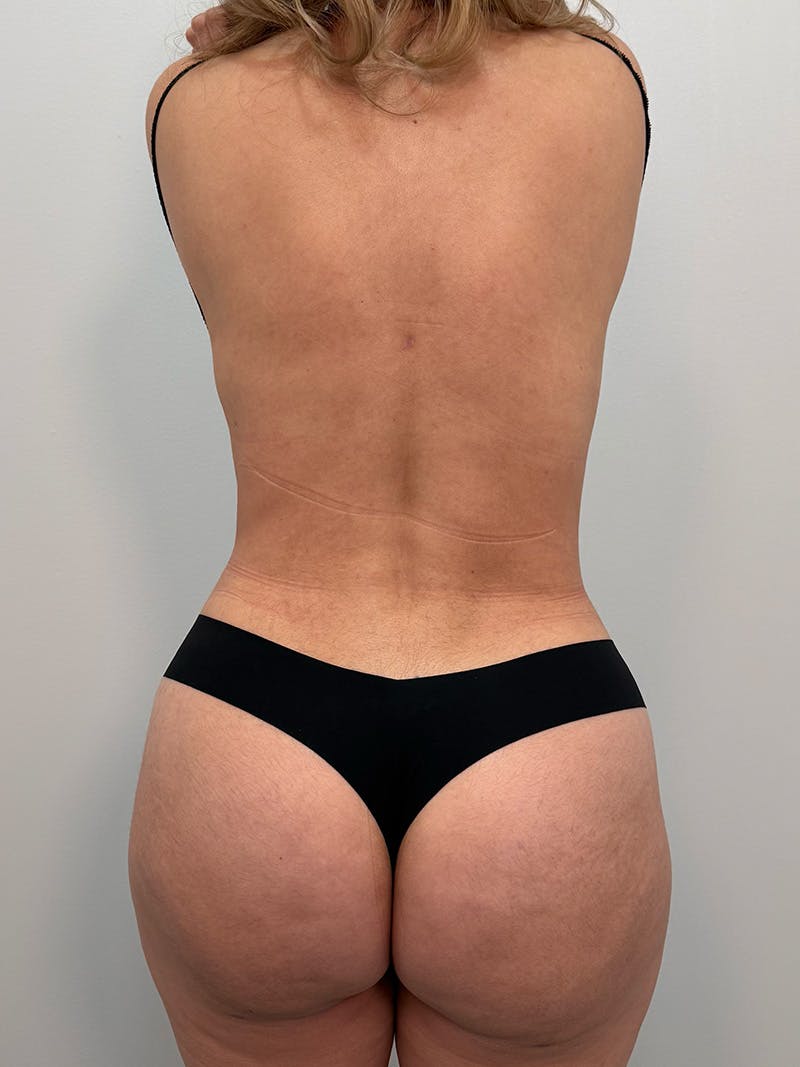 Brazilian Butt Lift Before & After Gallery - Patient 823915 - Image 2