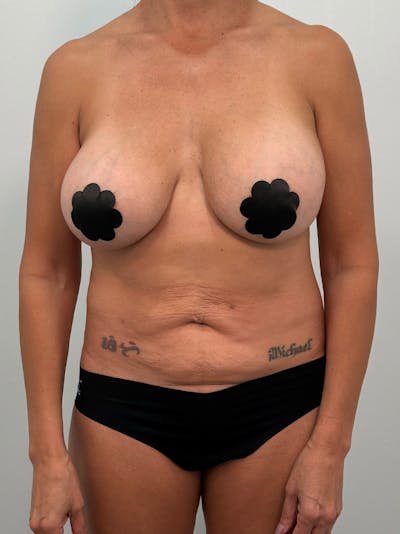 Mommy Makeover Before & After Gallery - Patient 138989 - Image 1