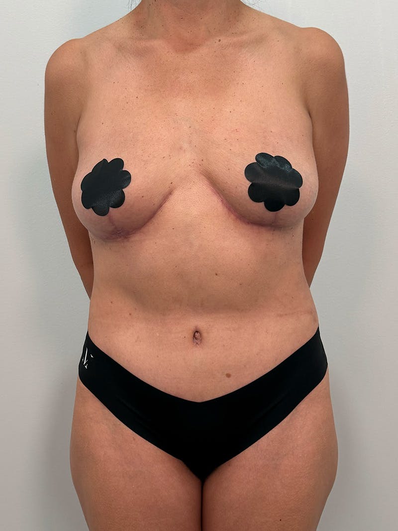 Mommy Makeover Before & After Gallery - Patient 138989 - Image 2