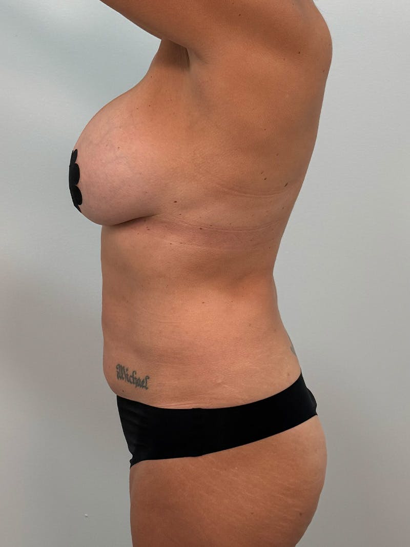 Mommy Makeover Before & After Gallery - Patient 138989 - Image 11