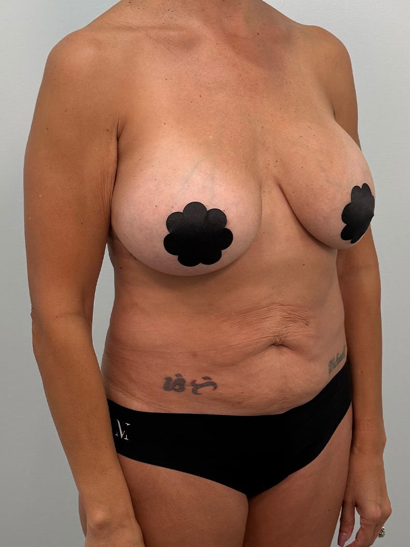 Mommy Makeover Before & After Gallery - Patient 138989 - Image 3