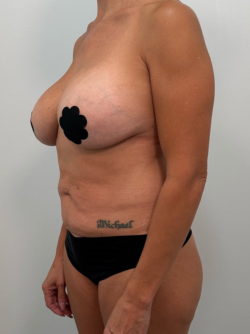 Mommy Makeover Before & After Gallery - Patient 138989 - Image 9