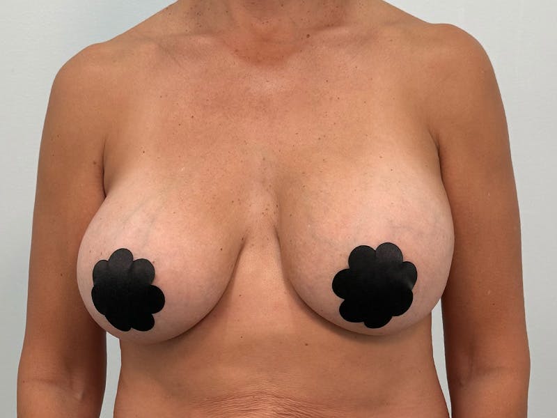 Breast Augmentation-Mastopexy Before & After Gallery - Patient 219491 - Image 1