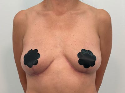 Breast Augmentation-Mastopexy Before & After Gallery - Patient 219491 - Image 2