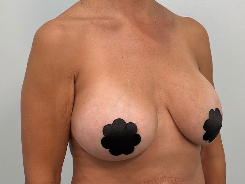 Breast Augmentation-Mastopexy Before & After Gallery - Patient 219491 - Image 3