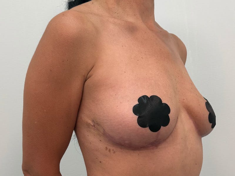 Breast Augmentation-Mastopexy Before & After Gallery - Patient 219491 - Image 4