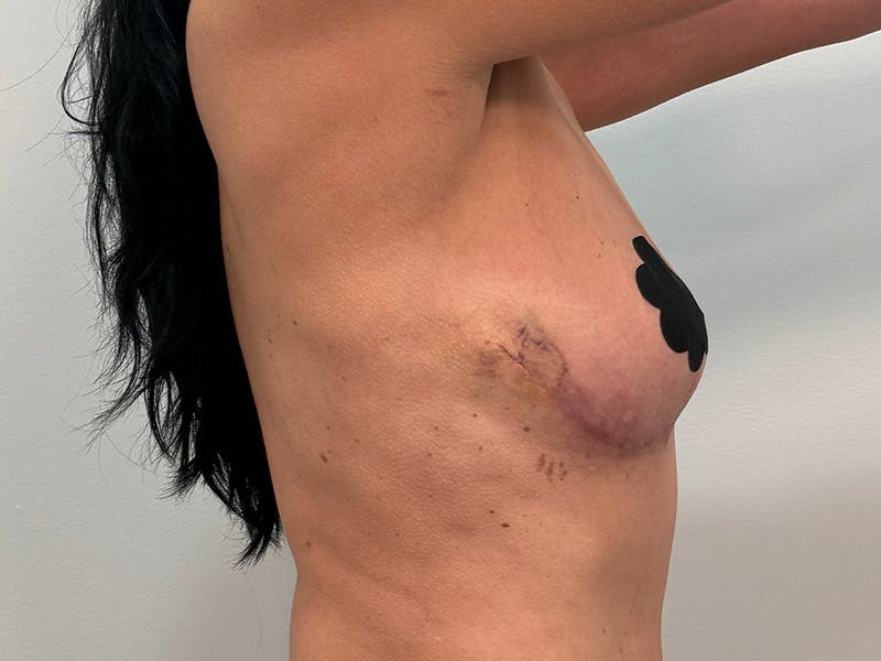 Breast Augmentation-Mastopexy Before & After Gallery - Patient 219491 - Image 8