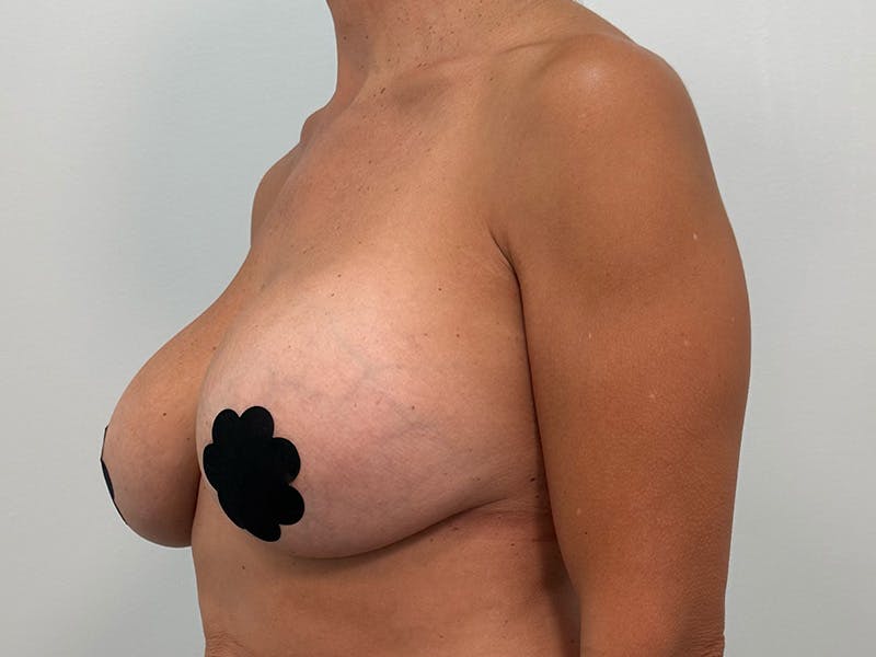 Breast Augmentation-Mastopexy Before & After Gallery - Patient 219491 - Image 9